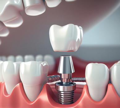 Implant Dentistry
